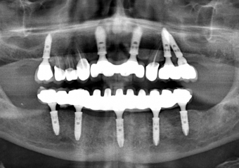 Raio X final com próteses fixas instaladas - Clínica Cliniface