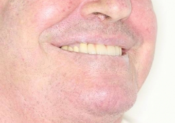 Sorriso final do caso terminado em 2012 - Clínica Cliniface