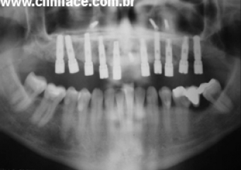 Raio X após instalação dos implantes - Clínica Cliniface