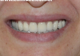 Prótese fixa de porcelana com dentes individuais - Clínica Cliniface