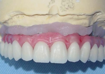 Imagens da prótese de porcelana com dentes individuais, ainda no laboratório - Clínica Cliniface