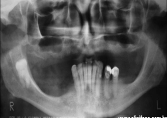 Raio X inicial - Clínica Cliniface