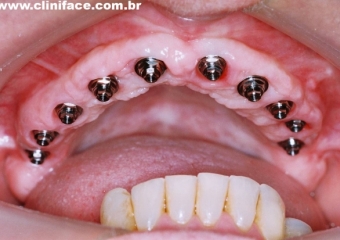 Implantes e minipilares instalados - Clínica Cliniface