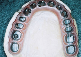 Imagens da prótese no laboratório - Clínica Cliniface