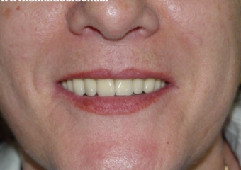  Sorriso final, do caso terminado em Julho de 2009 - Clínica Cliniface