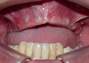 Imagem após enxerto ósseo na maxila - Clínica Cliniface