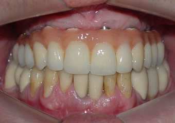  Prótese fixa em porcelana superior - Clínica Cliniface