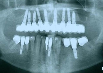 Raio X da prótese fixa em porcelana superior - Clínica Cliniface