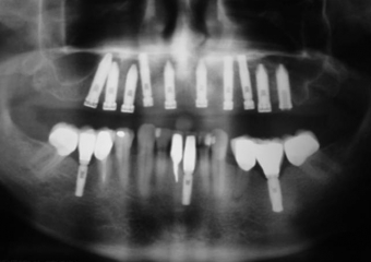 Raio X dos implantes - Clínica Cliniface