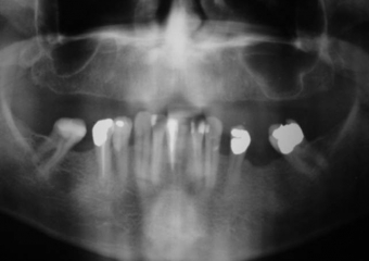 Raio X inicial - Clínica Cliniface