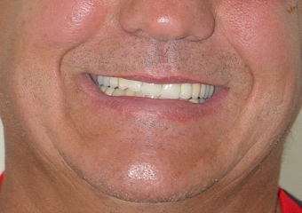 Sorriso do caso terminado em abril de 2012 - Clínica Cliniface