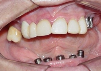 Imagem Implantes Instalados - Clínica Cliniface