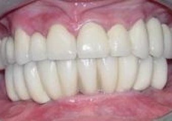 Imagem Final Intra Oral - Clínica Cliniface