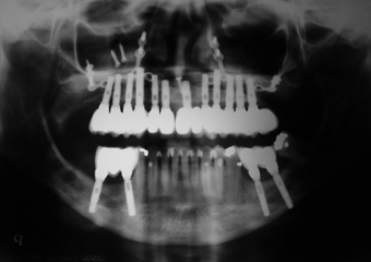 Raio X final com implantes e prótese de porcelana fixa - Clínica Cliniface