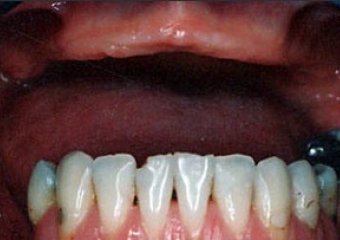 Paciente portadora de dentadura - Clínica Cliniface