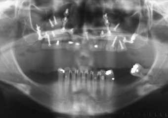 Raio X após avanço maxilar e enxerto ósseo - Clínica Cliniface