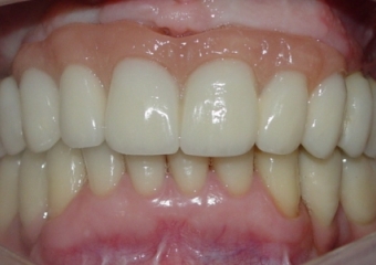 Prótese fixa instalada sobre implantes - Clínica Cliniface