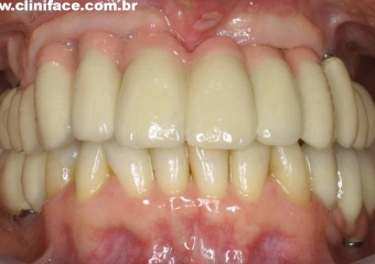 Prótese fixa em porcelana instalada sobre os implantes - Clínica Cliniface