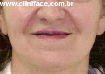 Sorriso inicial - Clínica Cliniface