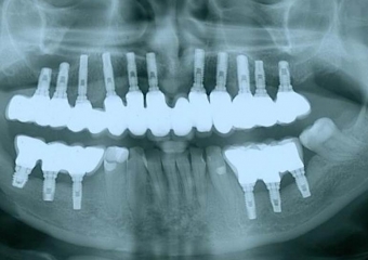 Raio X  de controle, 24 meses após instalação das próteses fixas sobre implantes - Clínica Cliniface
