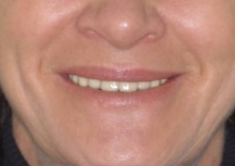 Sorriso final do caso terminado em julho de 2009 - Clínica Cliniface