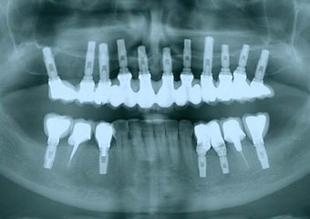 Raio X com prótese definitivas instaladas - Clínica Cliniface