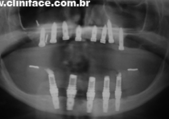 Raio X após instalação dos implantes - Clínica Cliniface