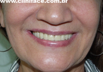 Imagens com prótese provisória fixa sobre implantes - Clínica Cliniface