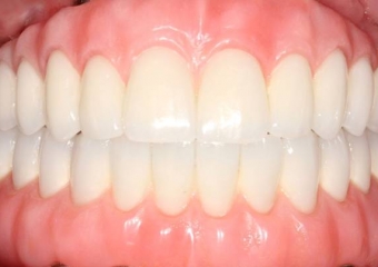 Próteses fixas em porcelana sobre implantes - Clínica Cliniface