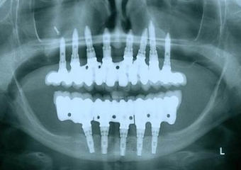 Raio X final, com as próteses em porcelana já instaladas - Clínica Cliniface