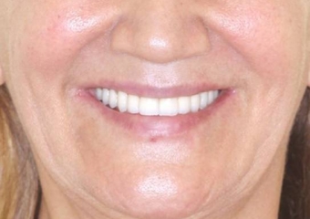 Sorriso final do caso terminado em Dezembro de 2011 - Clínica Cliniface