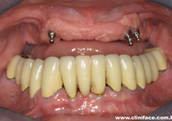 Imagem intra oral inicial - Clínica Cliniface