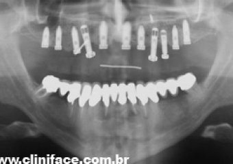 Raio X com os implantes superiores instalados - Clínica Cliniface