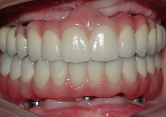 Imagens finais do caso terminado em agosto de 2010 - Clínica Cliniface