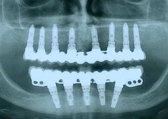 Raio X de 24 meses de controle - Clínica Cliniface