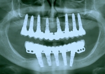 Raio X final - Clínica Cliniface