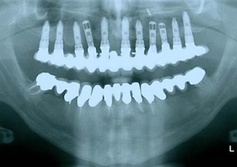 Raio X com protese fixa superior em porcelana sobre implantes - Clínica Cliniface