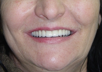 Sorriso final - Clínica Cliniface