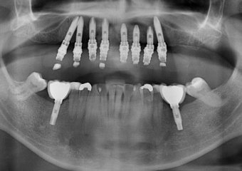 Rx com prótese fixa provisória sobre implantes superiores - Clínica Cliniface