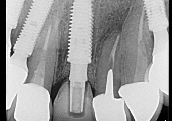 Rx controle de 2 meses - Clínica Cliniface