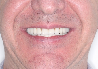 Sorriso Final em 2015 - Clínica Cliniface