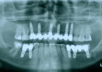 Rx Final - Clínica Cliniface