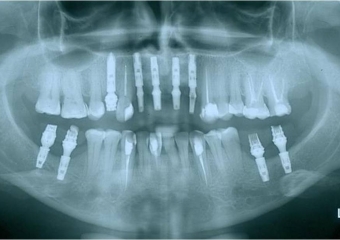 Raio x com próteses provisórias sobre implantes cone morse - Clínica Cliniface