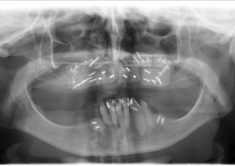 Raio x enxerto maxila e mandíbula, com osso autógeno de calota craniana, em 2010 - Clínica Cliniface