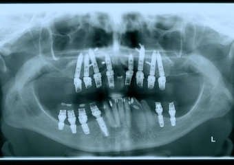 Raio x implantes inferiores instalados e com próteses fixas provisórias superior e inferior, em 2012 - Clínica Cliniface