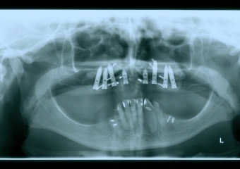 Raio x implantes superiores instalados, em 2011 - Clínica Cliniface