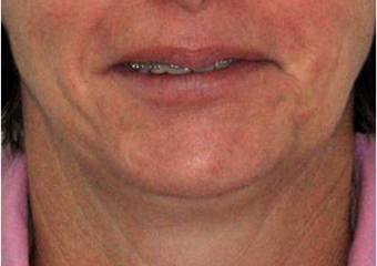 Imagem inicial com assimetria de face - Clínica Cliniface