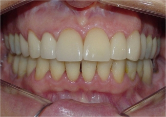 Mordida final - Clínica Cliniface