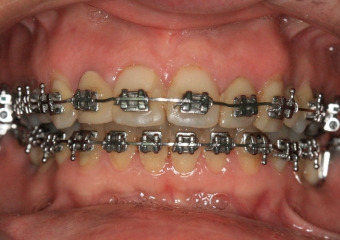 Mordida inicial - Clínica Cliniface