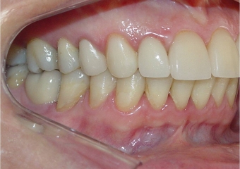 Mordida perfil final - Clínica Cliniface